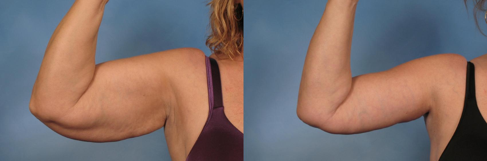 Before & After Arm Lift Case 133 View #1 View in Naples and Ft. Myers, FL