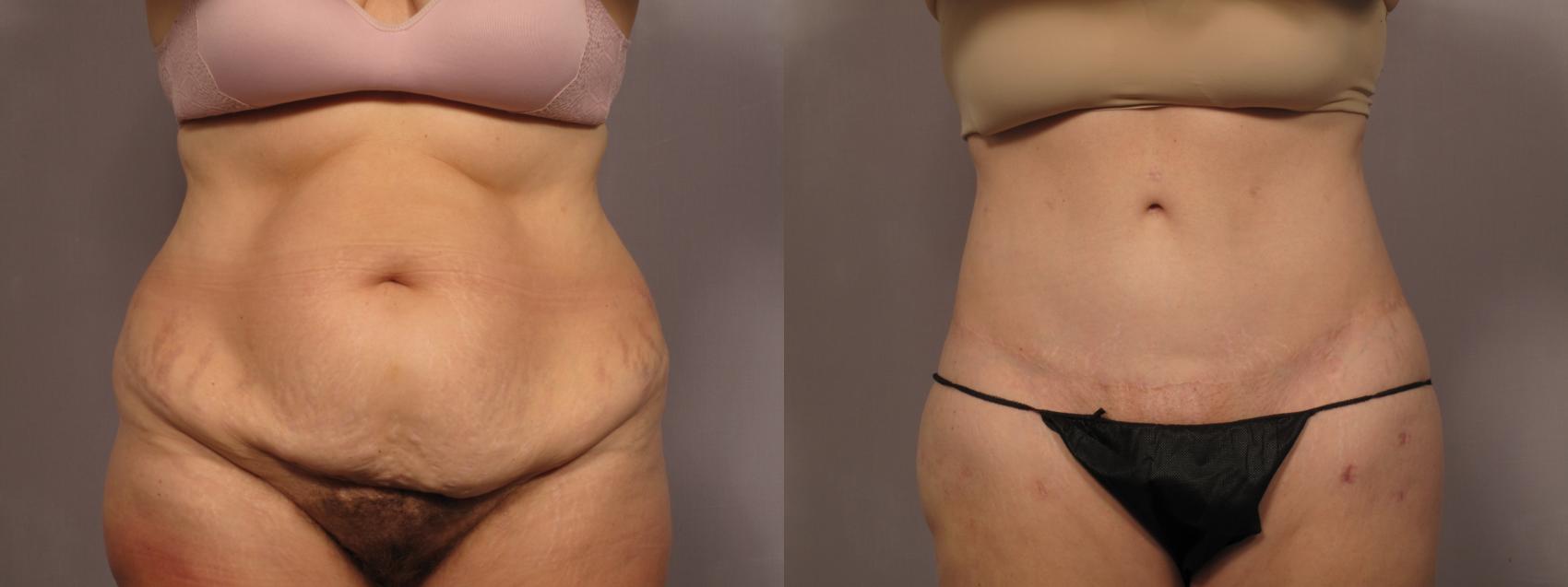 Before Body Lift after MWL, Front view