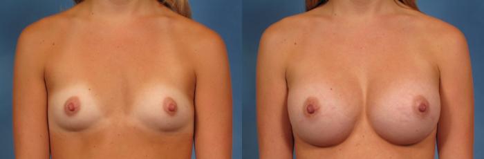 Before & After Breast Augmentation Case 144 View #1 View in Naples and Ft. Myers, FL