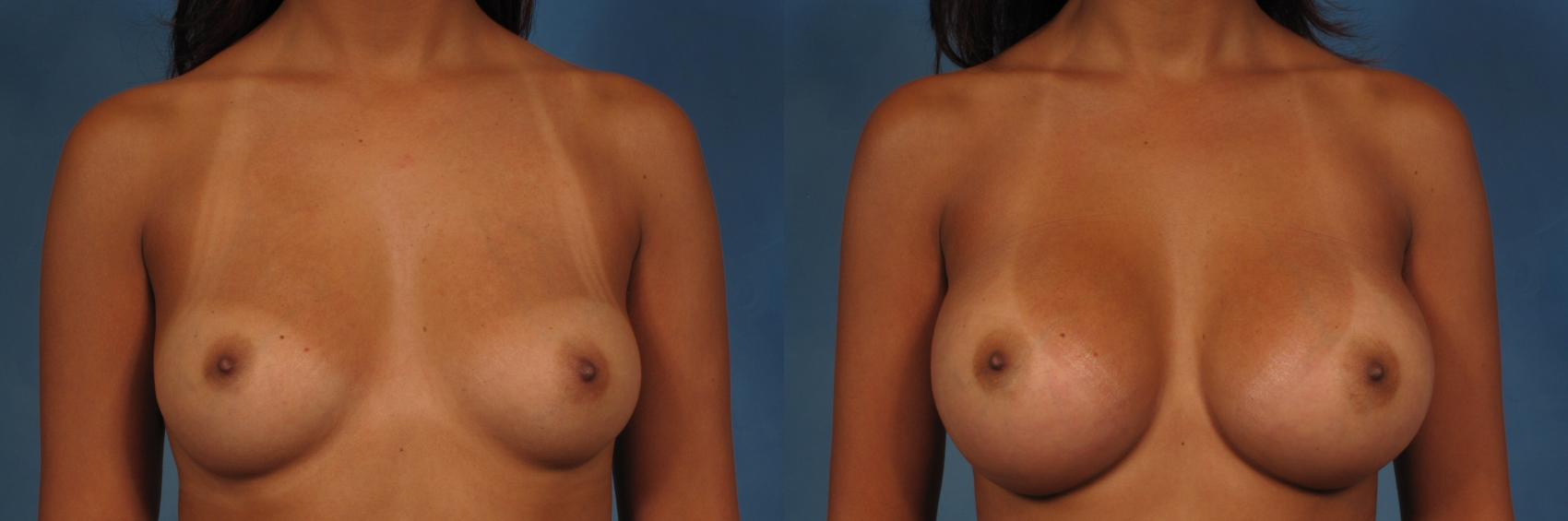 Before & After Breast Augmentation Case 233 View #4 View in Naples and Ft. Myers, FL