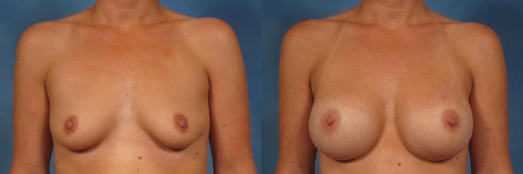 Front view of Silicone Breast Augmentation by Dr. Kent Hasen in 46 year old woman, Before