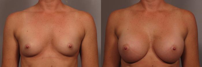Front view of 31 year old female patient of Dr. Kent Hasen Underwent Breast Augmentation, Before