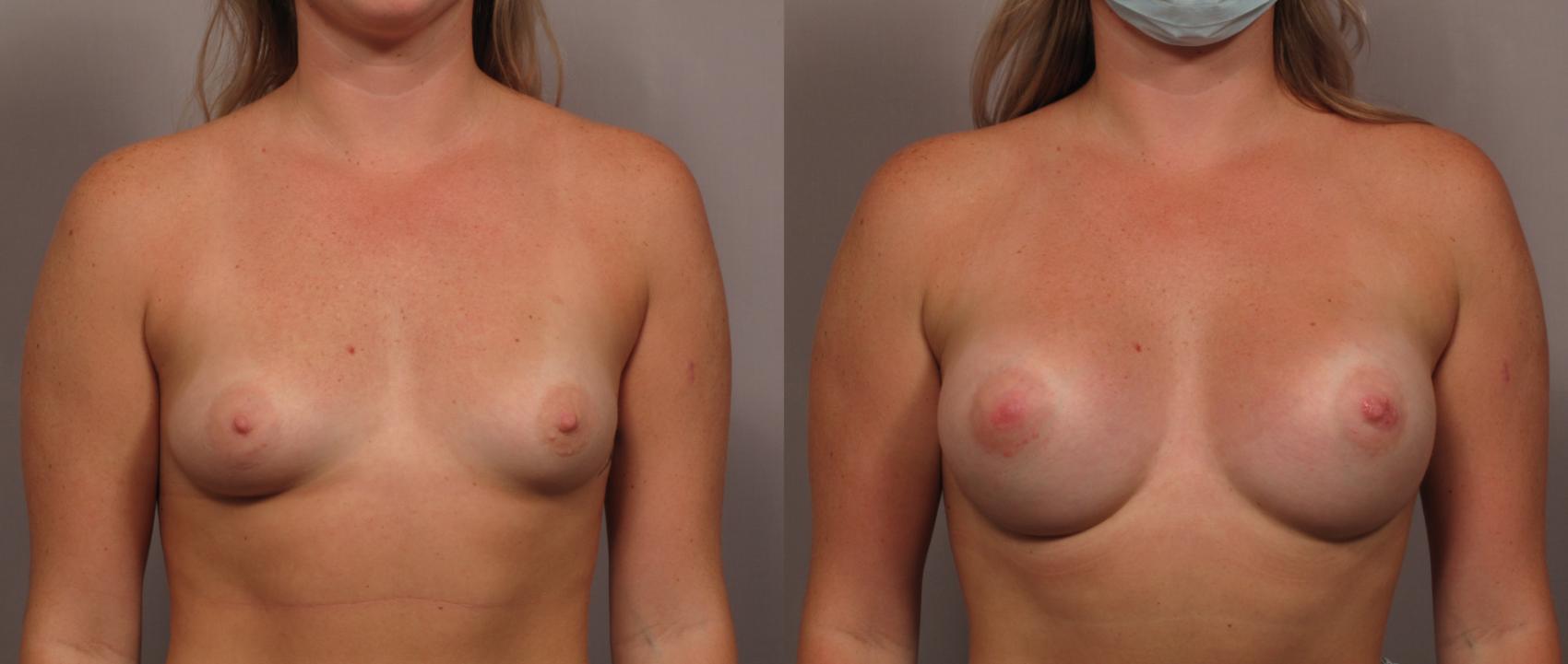 Breast Augmentation Frontal View Before