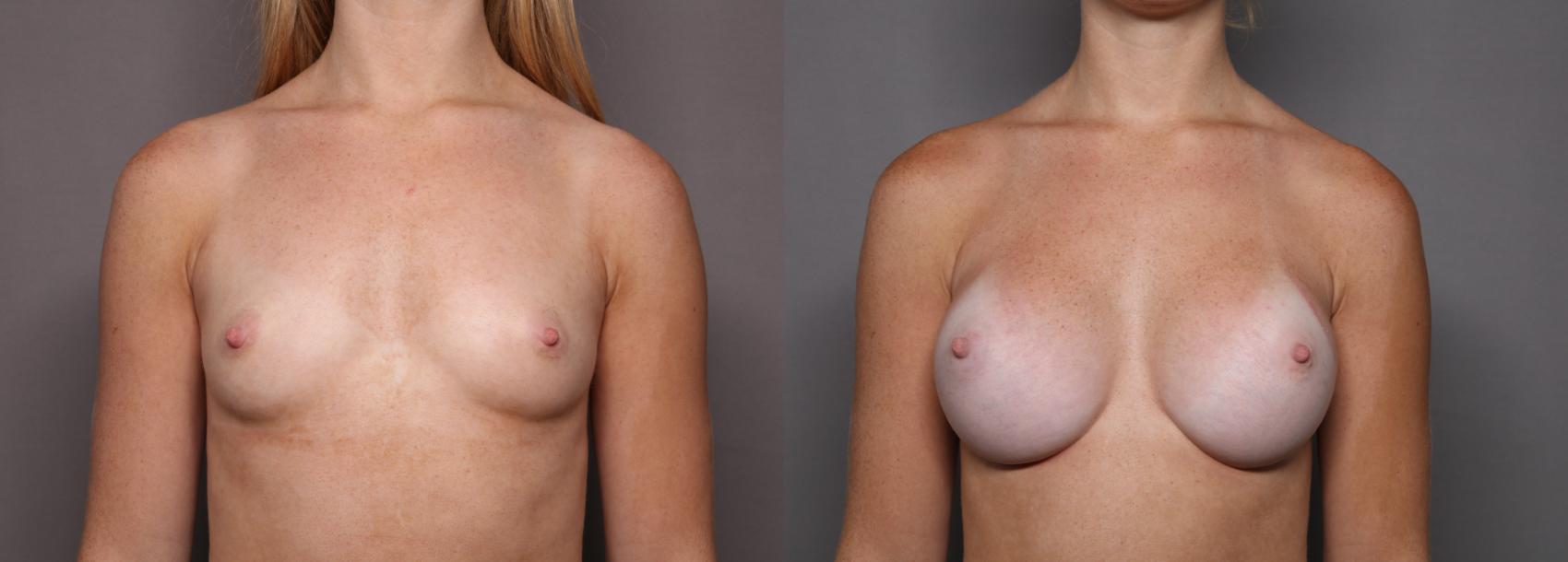Breast Augmentation Frontal View Before