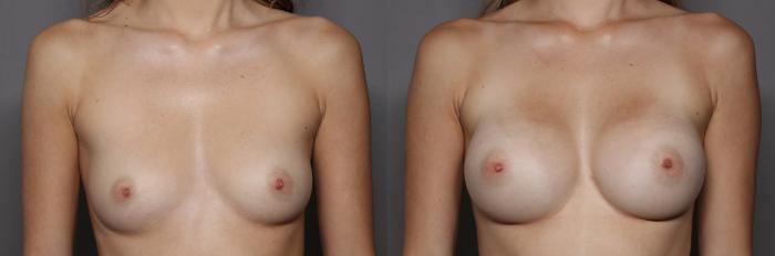Frontal, Pre-op View