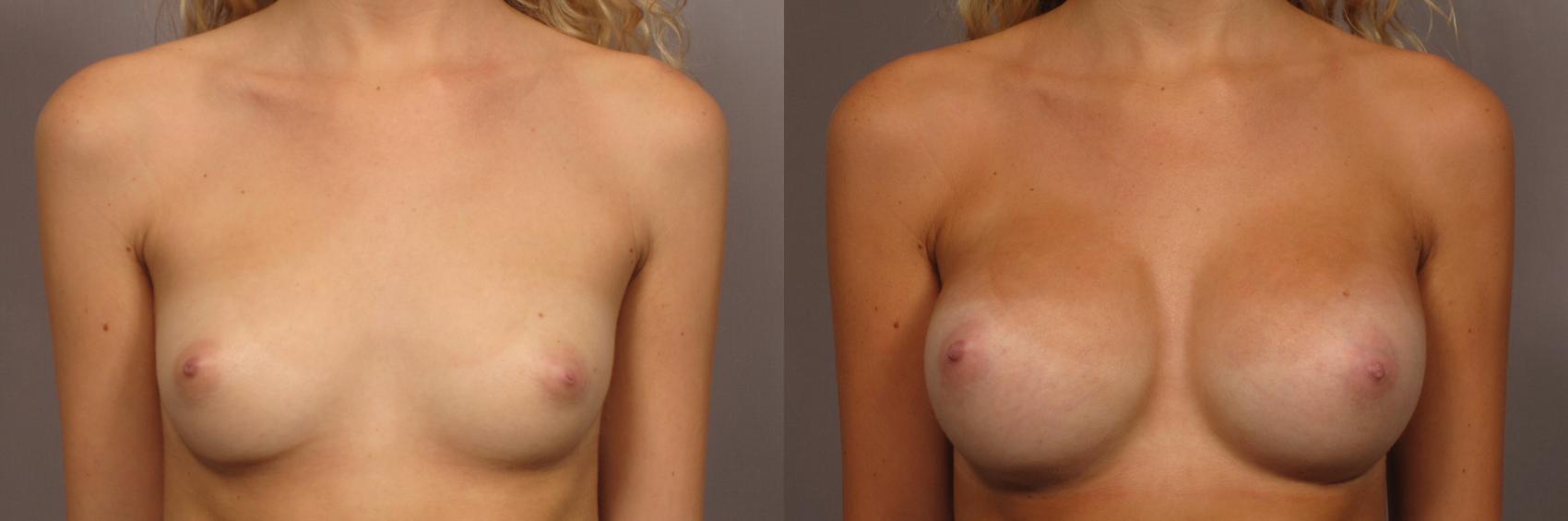 Front view, pre-op