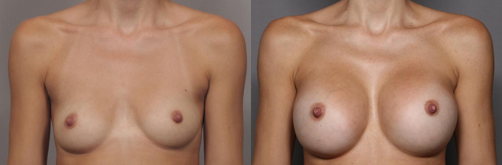 Front View, Pre-op Breast Augmentation with Silicone Implants