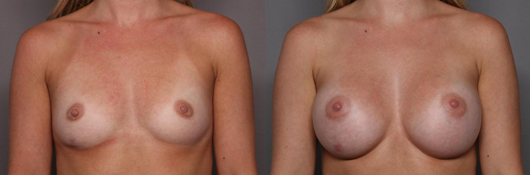 Front View, Pre-op Breast Augmentation with Mentor Boost Silicone Implants
