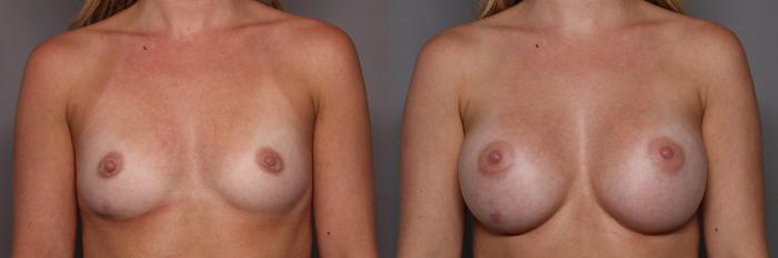 Front View, Pre-op Breast Augmentation with Mentor Boost Silicone Implants