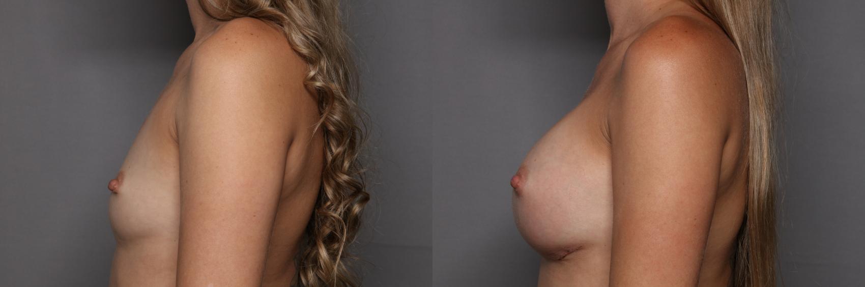 Left Side, preop for Motiva Breast Augmentation
