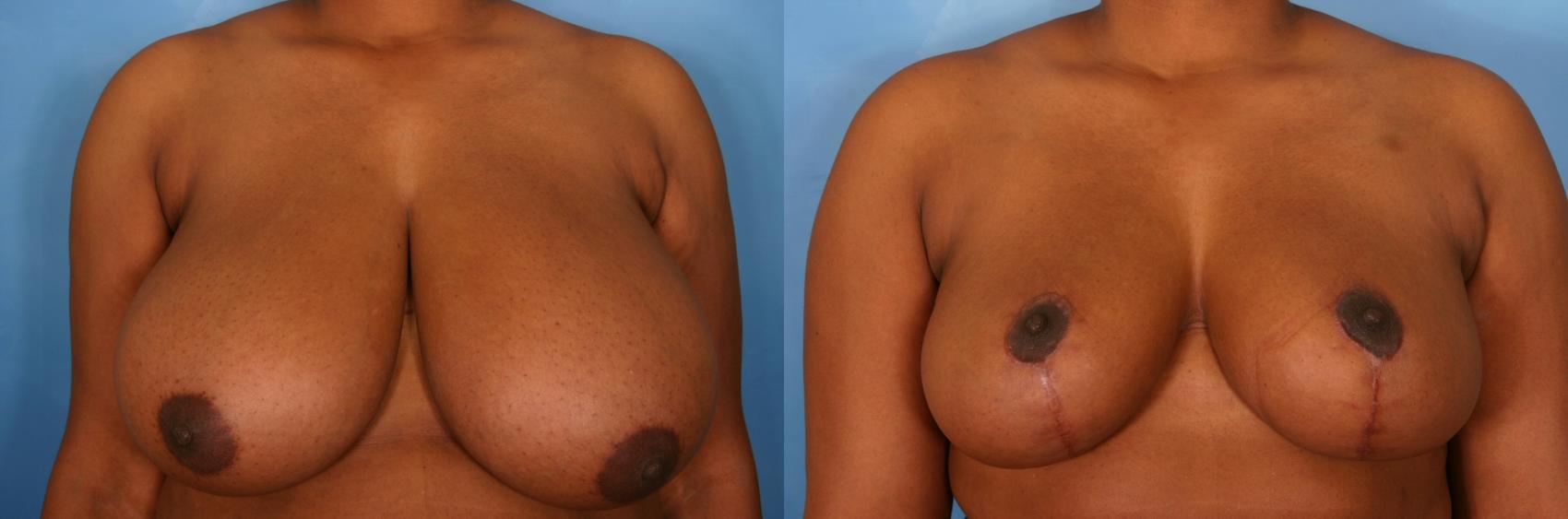 Before & After Breast Reduction Case 33 View #1 View in Naples and Ft. Myers, FL