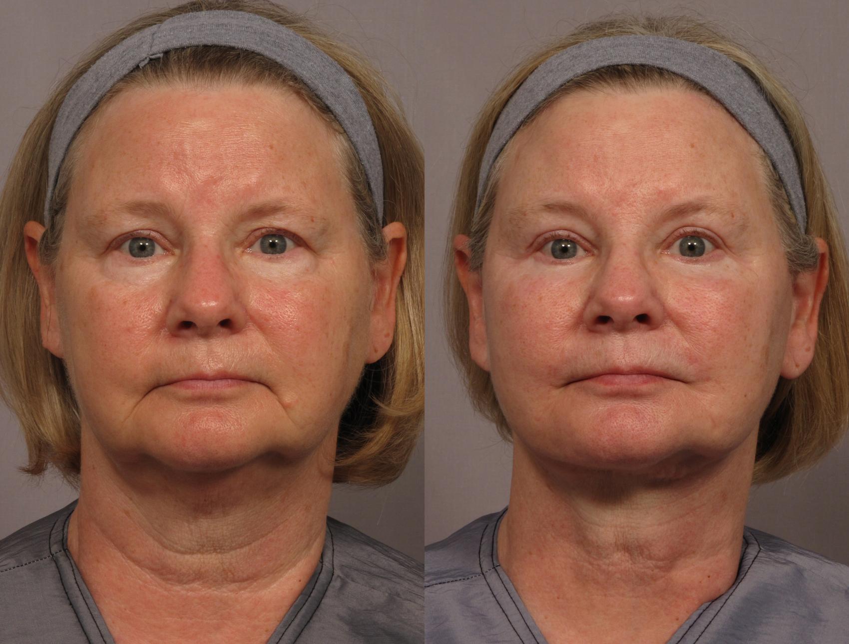Before & After Brow Lift Case 325 View #1 View in Naples and Ft. Myers, FL