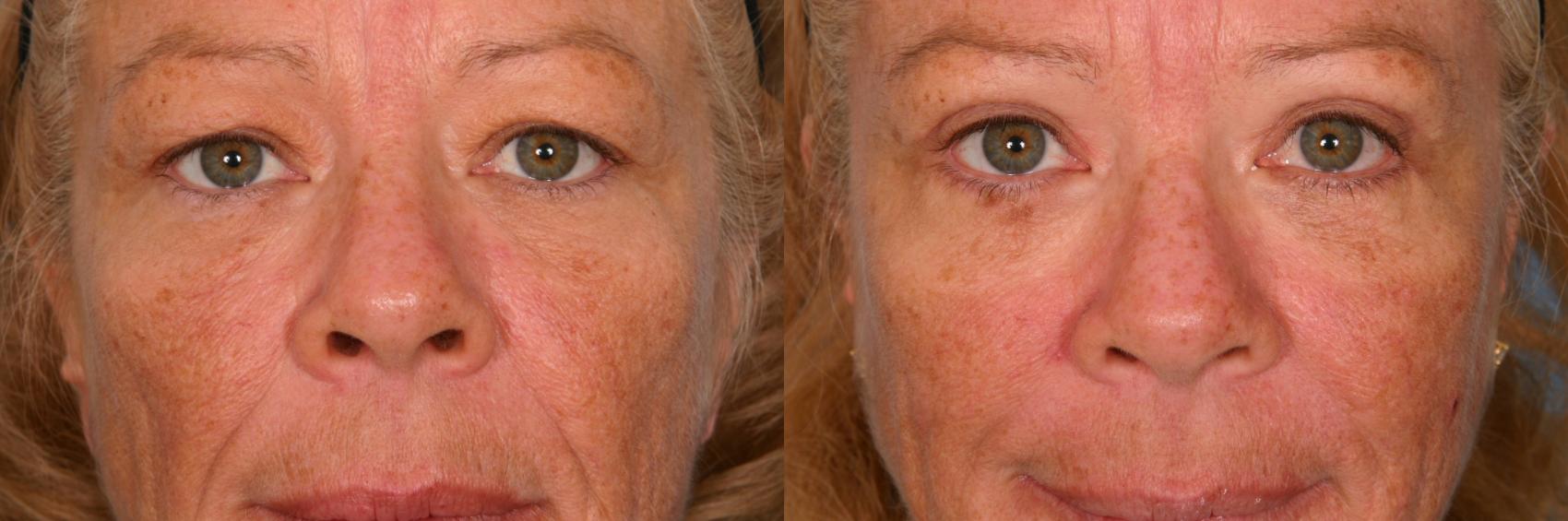 Before & After Brow Lift Case 54 View #1 View in Naples and Ft. Myers, FL