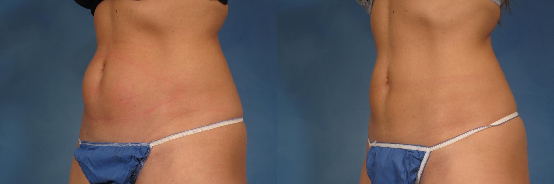 Before & After CoolSculpting Elite Case 155 View #1 View in Naples, FL