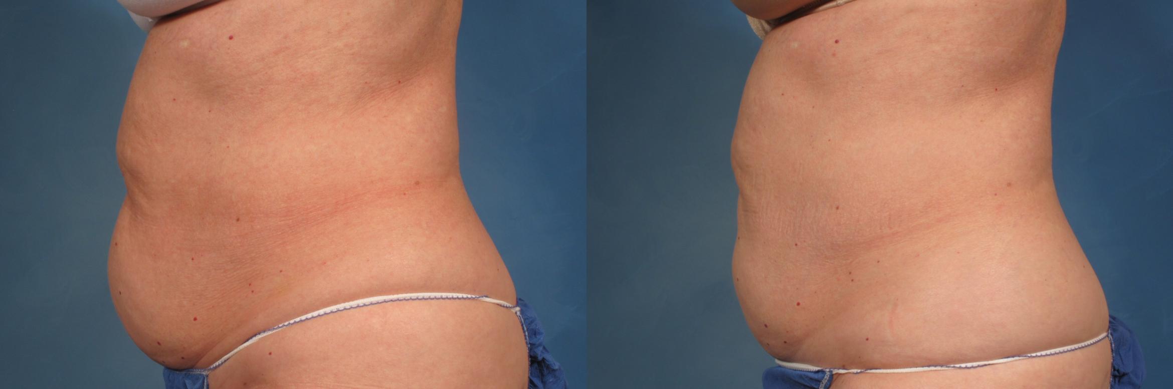 Before & After CoolSculpting Elite Case 190 View #1 View in Naples, FL