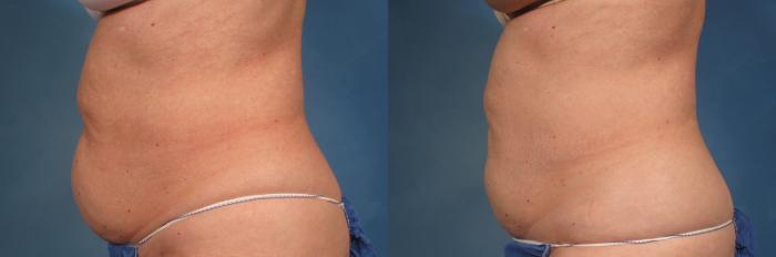 Before & After CoolSculpting Elite Case 190 View #1 View in Naples and Ft. Myers, FL