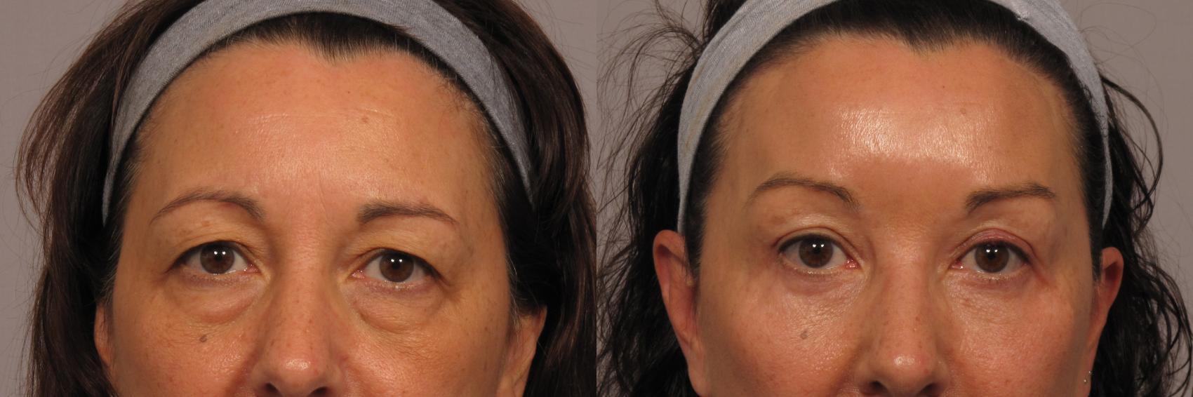 Front View of Patient who underwent eyelid lift and brow lift