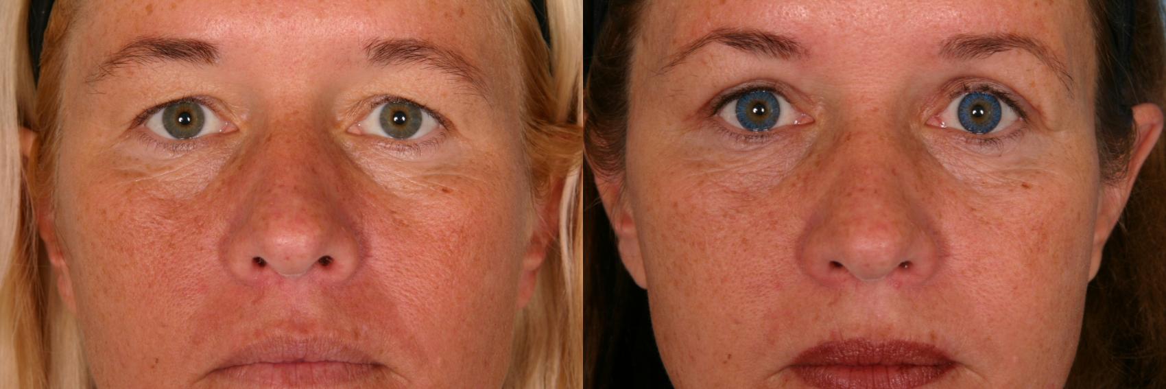 Before & After Eyelid Lift (Blepharoplasty) Case 51 View #1 View in Naples and Ft. Myers, FL