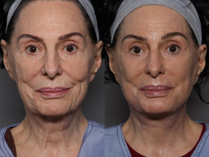 Front View, Pre-op Deep Plane Facelift with Sciton Contour TRL Laser Resurfacing
