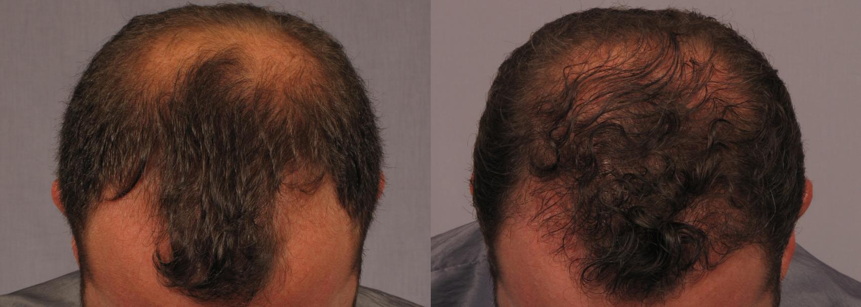 Before & After FUE Results Achieved with SmartGraft or Neograft Case 298 View #1 View in Naples and Ft. Myers, FL