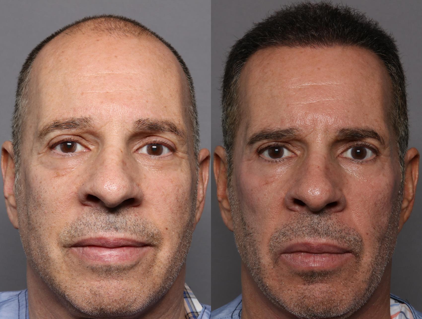 Before SmartGraft Hair Restoration, Front View