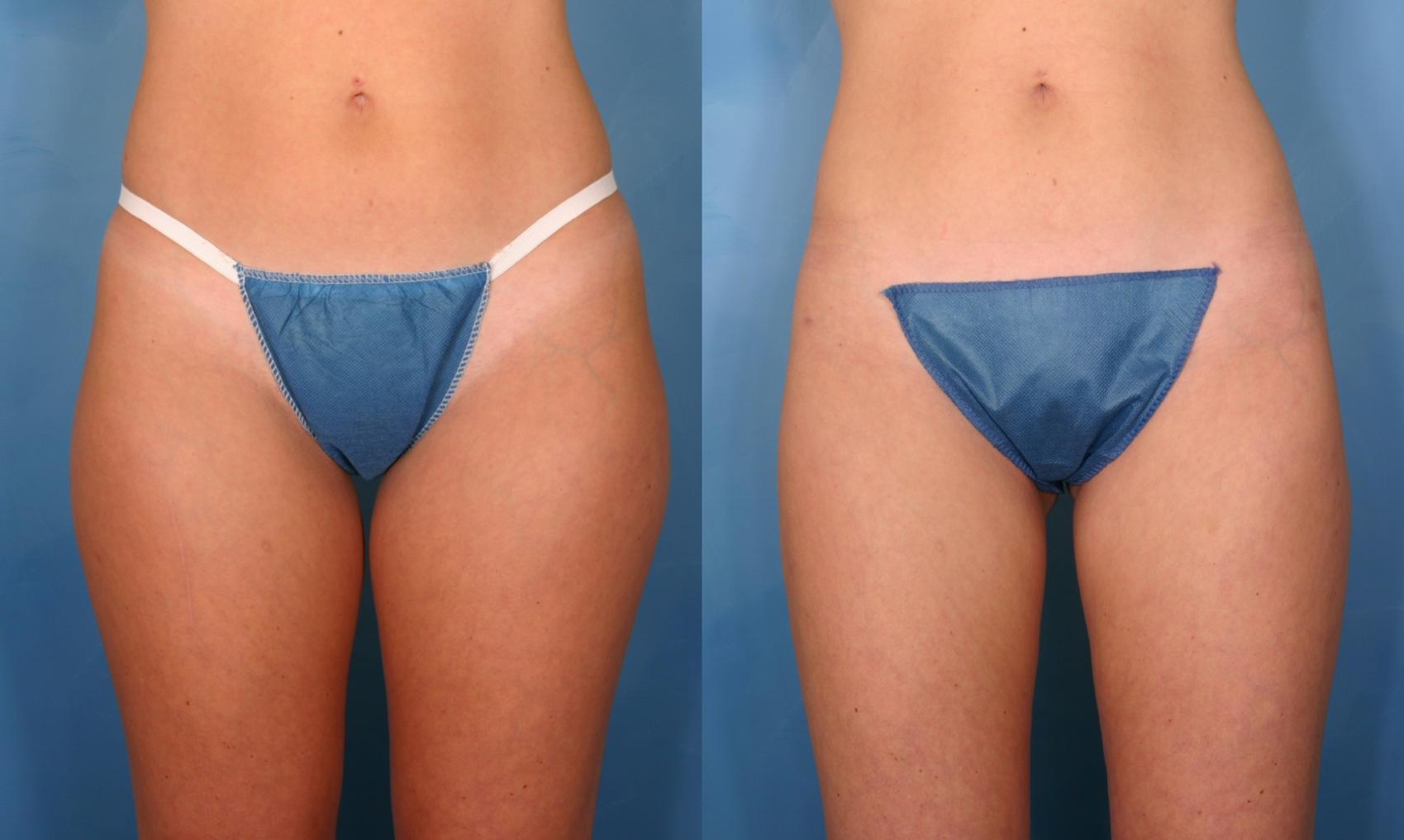 Before & After Liposuction Case 25 View #1 View in Naples and Ft. Myers, FL