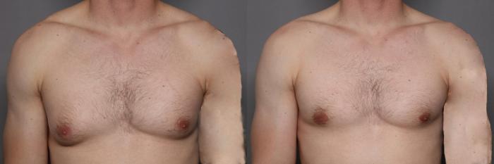 Front View of Gynecomastia (Male Breast Reduction) in Naples Florida