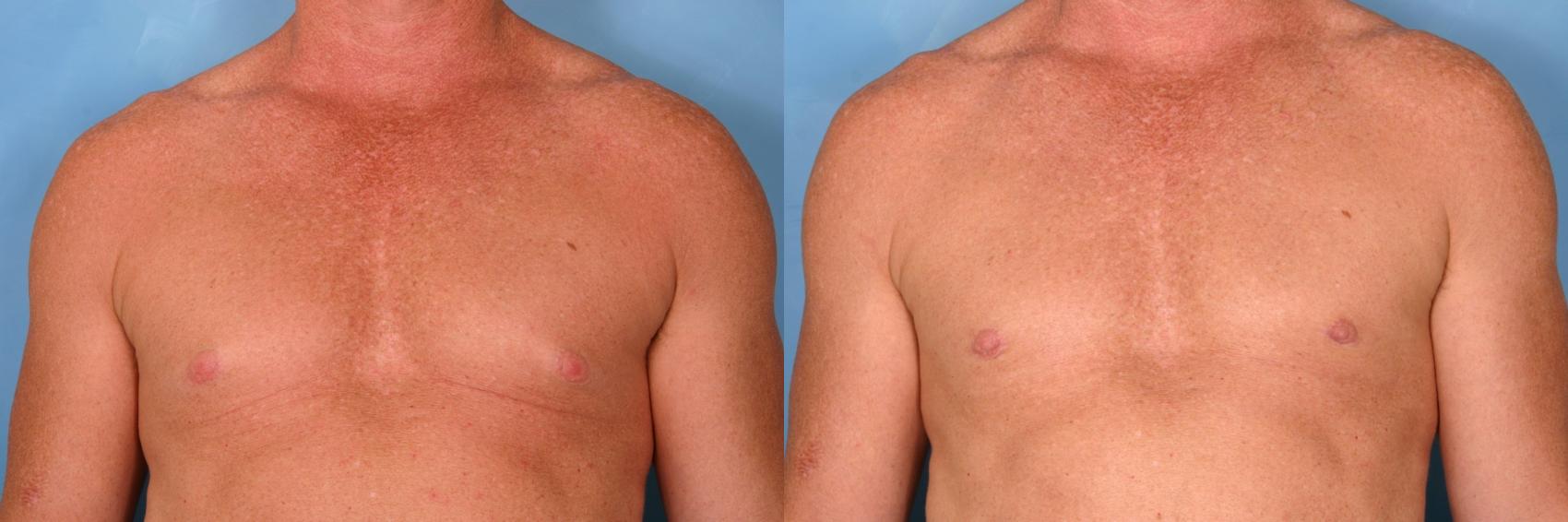 Before & After Male Breast Reduction Case 77 View #1 View in Naples and Ft. Myers, FL