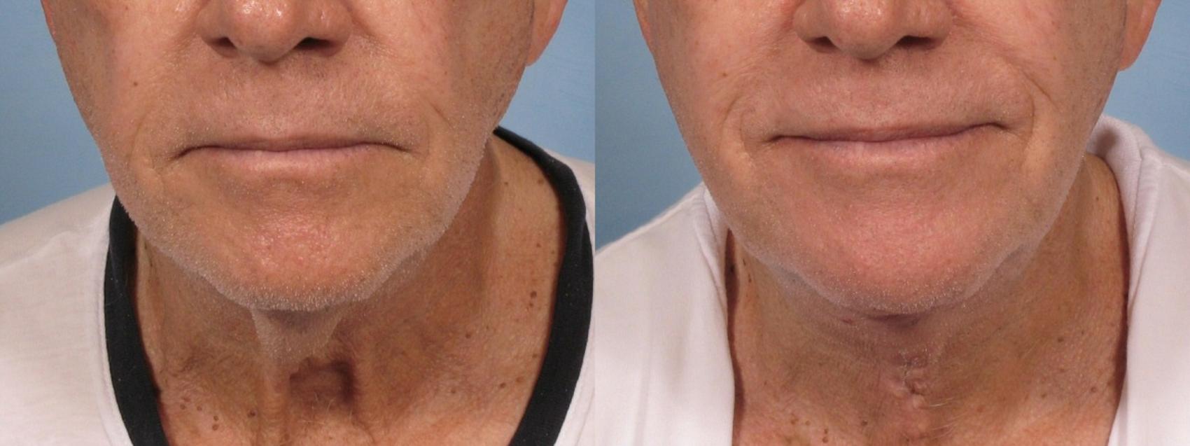 Before & After Neck Lift Case 187 View #1 View in Naples and Ft. Myers, FL
