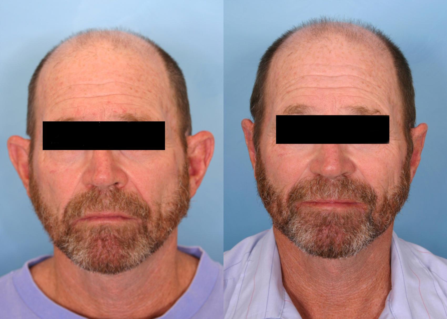 Before & After Otoplasty Case 46 View #1 View in Naples and Ft. Myers, FL