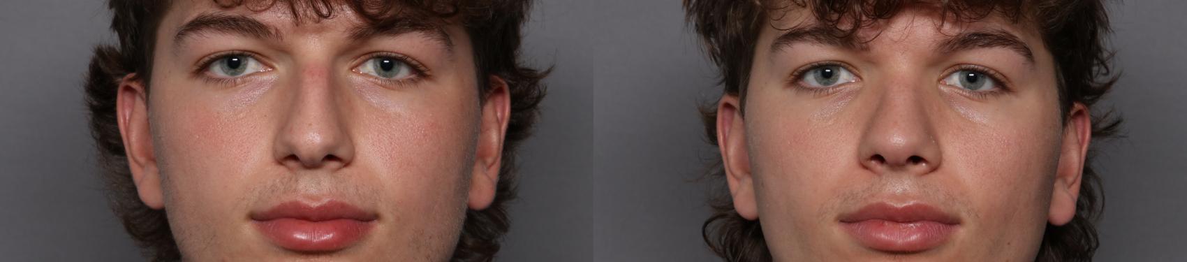 Rhinoplasty Frontal View Before
