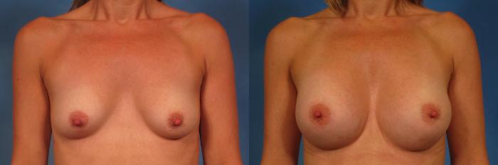 Before & After Silicone Breast Implants Case 279 View #1 View in Naples and Ft. Myers, FL