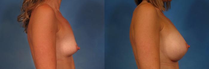 Before & After Silicone Breast Implants Case 279 View #2 View in Naples and Ft. Myers, FL