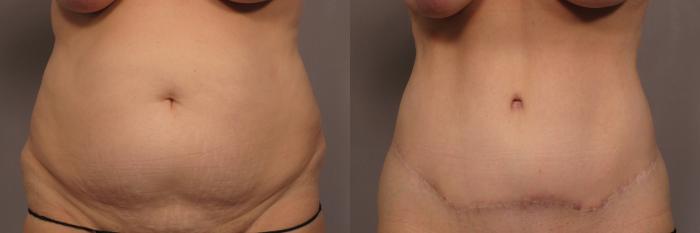 Tummy Tuck before and after photo,frontal view by Kent V. Hasen, MD in Naples, Florida