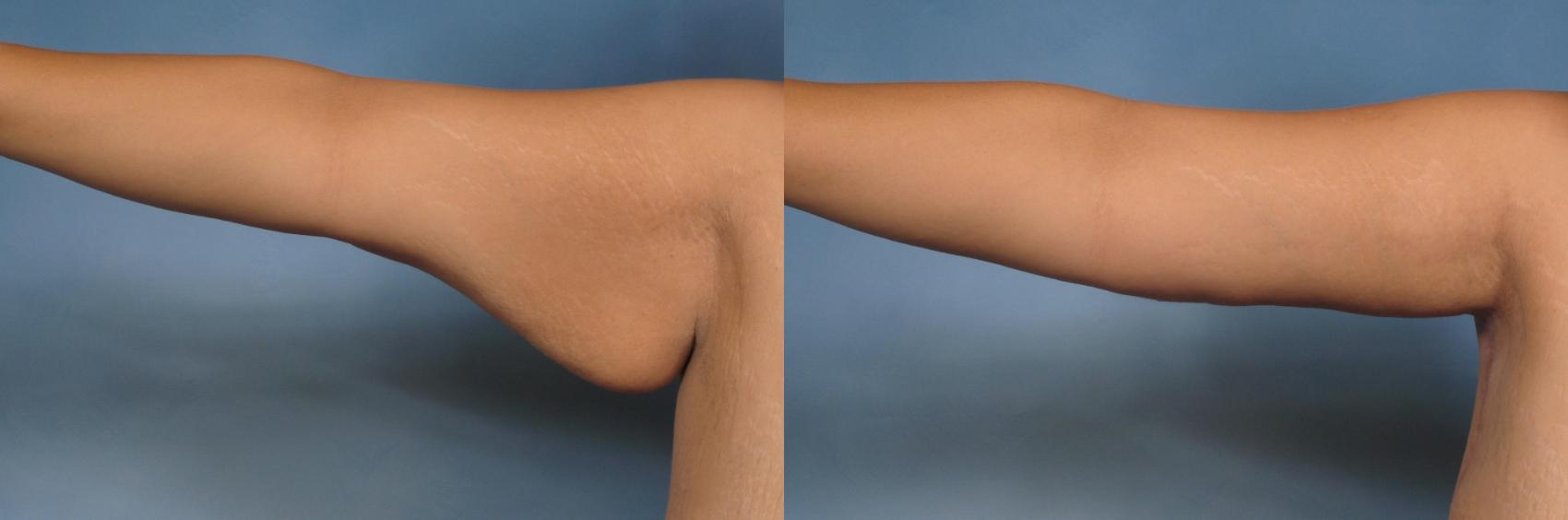 Before & After Arm Lift Case 132 View #1 View in Naples and Ft. Myers, FL