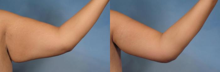 Before & After Arm Lift Case 132 View #2 View in Naples and Ft. Myers, FL