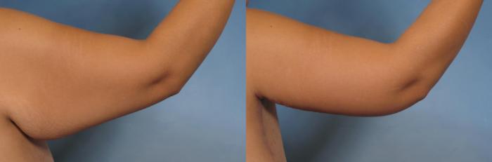 Before & After Arm Lift Case 132 View #3 View in Naples and Ft. Myers, FL