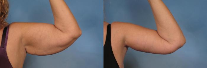 Before & After Arm Lift Case 133 View #2 View in Naples and Ft. Myers, FL