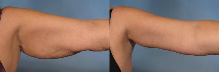 Before & After Arm Lift Case 133 View #3 View in Naples and Ft. Myers, FL