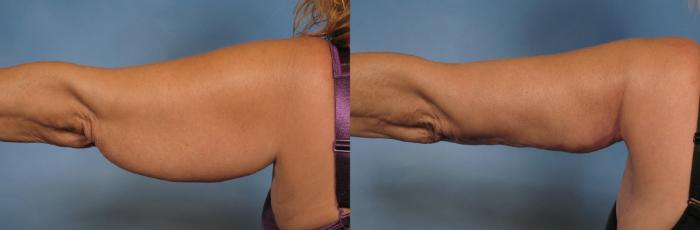 Before & After Arm Lift Case 133 View #4 View in Naples and Ft. Myers, FL