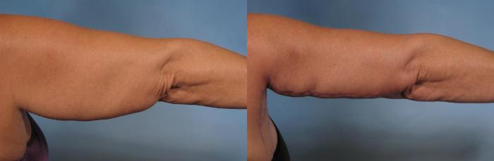 Before & After Arm Lift Case 133 View #5 View in Naples and Ft. Myers, FL