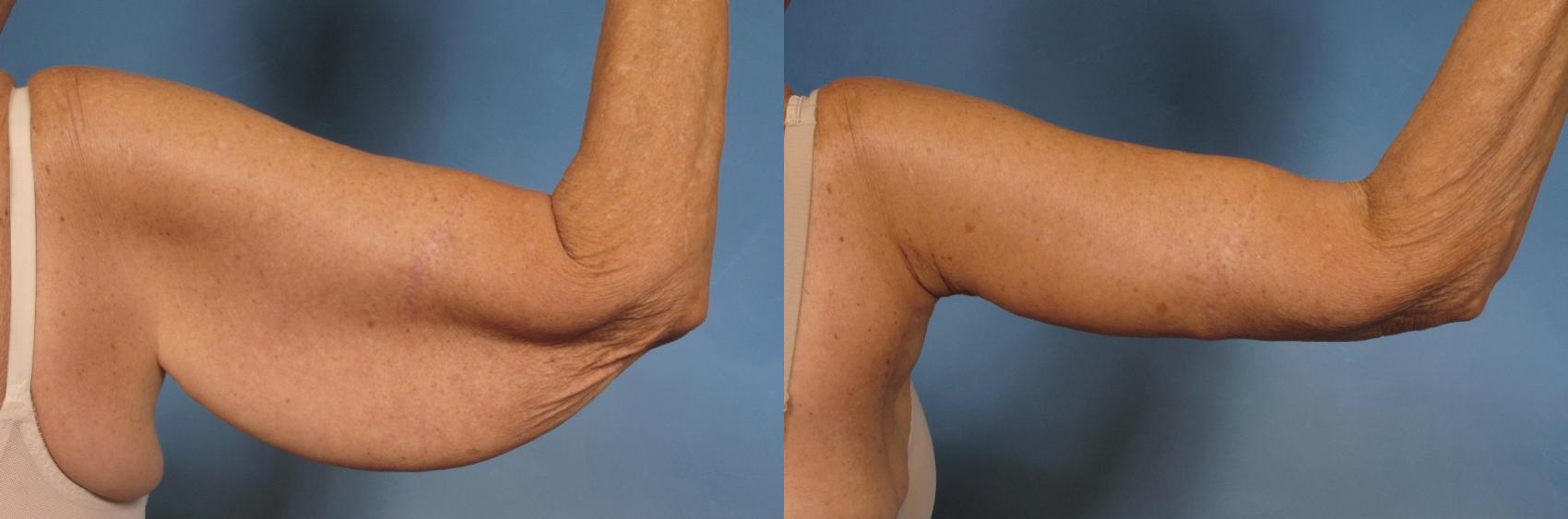 Before & After Arm Lift Case 174 View #1 View in Naples and Ft. Myers, FL
