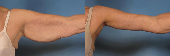 Before & After Arm Lift Case 174 View #2 View in Naples and Ft. Myers, FL