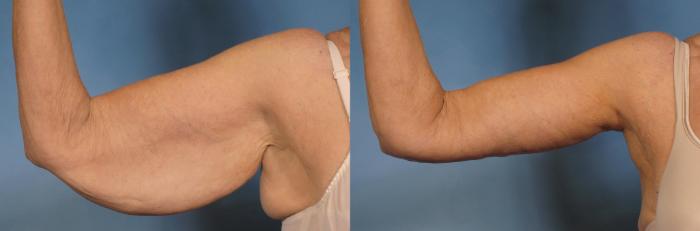 Before & After Arm Lift Case 174 View #3 View in Naples and Ft. Myers, FL