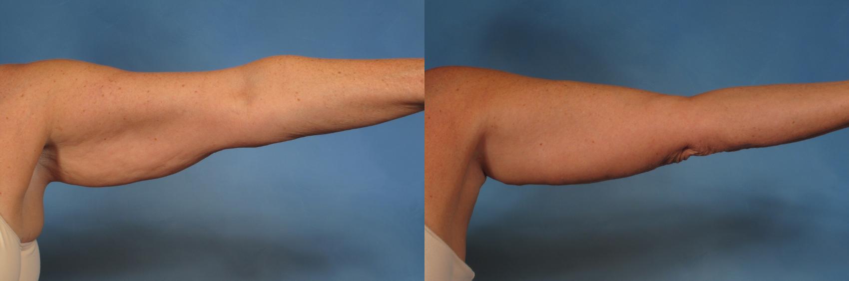 Before & After Arm Lift Case 193 View #1 View in Naples and Ft. Myers, FL