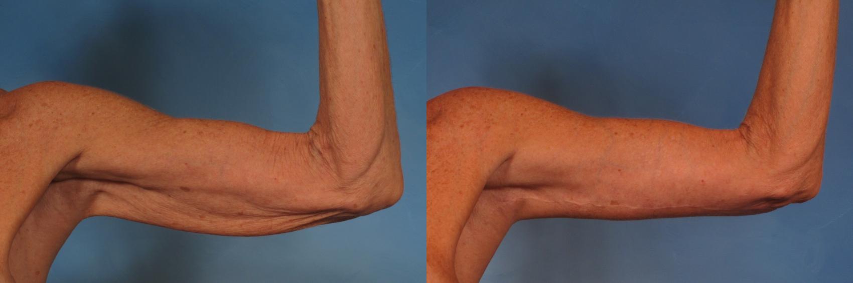 Cape Coral, FL Non Surgical Arm Tightening Procedures