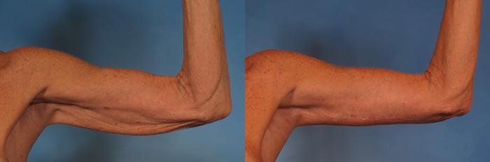 Before & After Arm Lift Case 246 View #1 View in Naples and Ft. Myers, FL