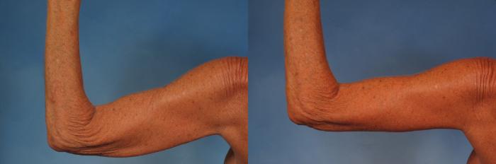 Before & After Arm Lift Case 246 View #3 View in Naples and Ft. Myers, FL
