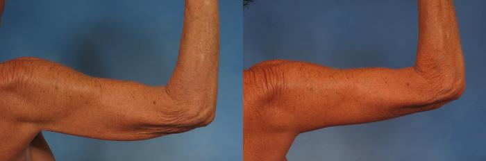 Before & After Arm Lift Case 246 View #4 View in Naples and Ft. Myers, FL
