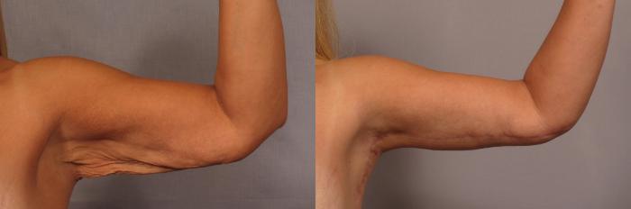 Arm Lift Before and 6 Months After, Left Inner Bent